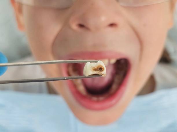 Best Emergency Dental Care for Abscessed Tooth in Hillcrest Heights, MD