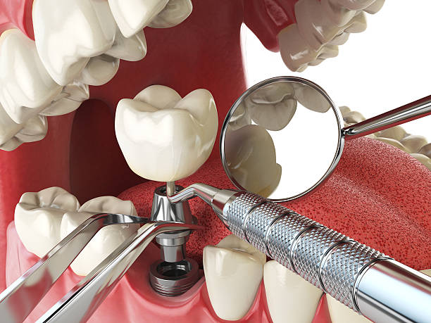 Best Emergency Dentist for Lost Fillings or Crowns in Hillcrest Heights, MD